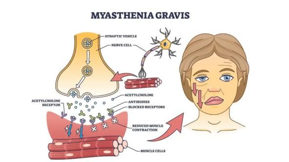 Myasthenia