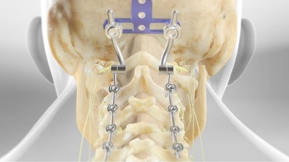 Occipitocervical Fusion