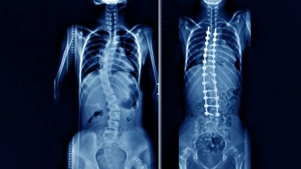 scoliosis and kyphosis surgery